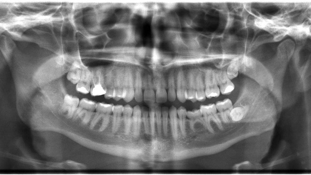 Un estudio refuerza la teoría sobre el origen del Alzhéimer: una infección en la boca