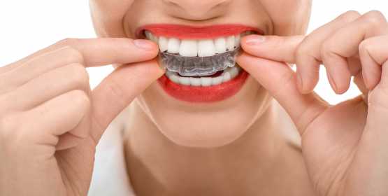 Ortodoncia Invisible (Invisalign)